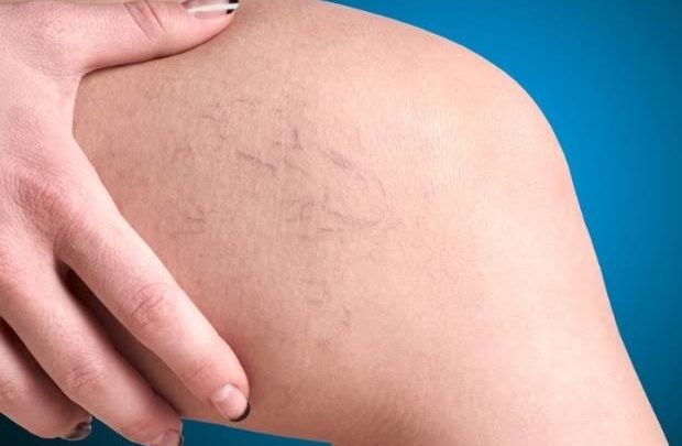 Tratar varizes no verão requer mais cuidados