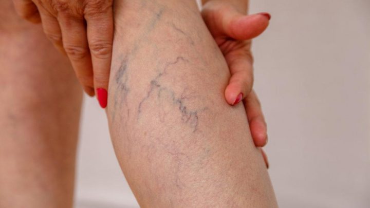 Varizes podem ser combatidas sem cirugia; Confira