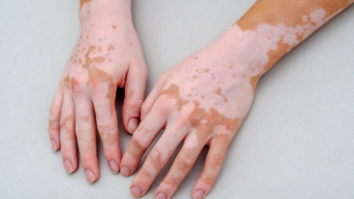 Vitiligo: o que é, sintomas, tratamentos e causas