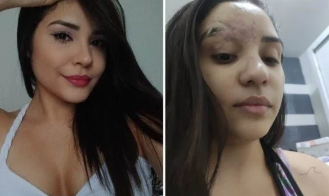 Estudante de Salgueiro retira vidro do rosto após 6 meses: “Consegui me ver de novo no espelho”