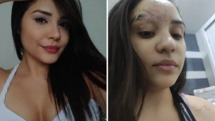 Estudante de Salgueiro retira vidro do rosto após 6 meses: “Consegui me ver de novo no espelho”