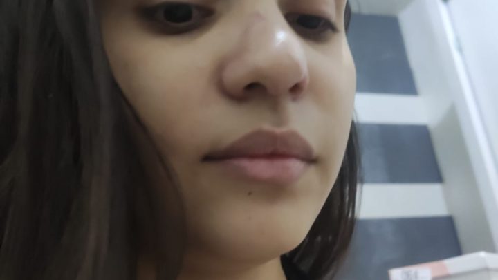Estudante de Salgueiro busca responsabilidade criminais do acidente que afundou a sua face