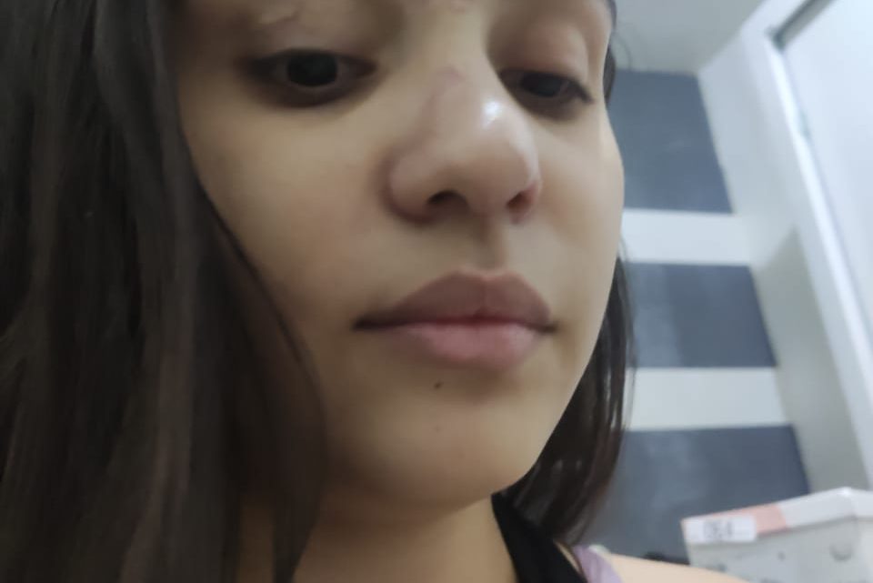Estudante de Salgueiro busca responsabilidade criminais do acidente que afundou a sua face Estudante de Salgueiro busca responsabilidade criminais do acidente que afundou a sua face
