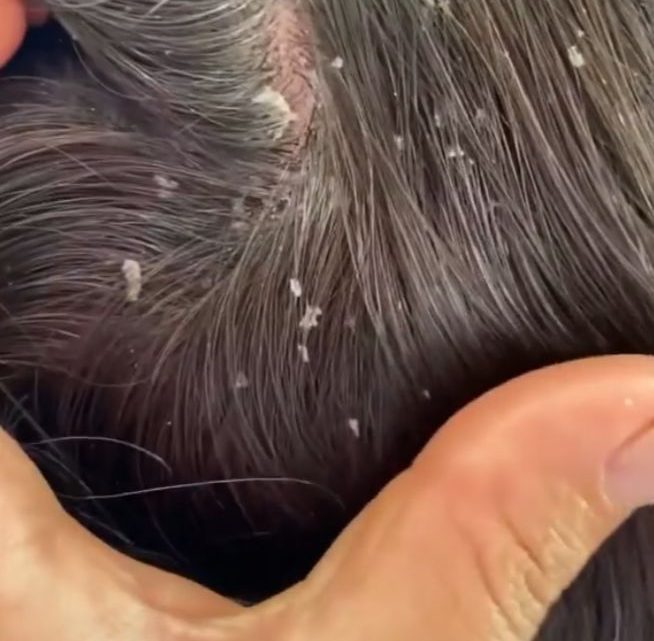 Terapeuta capilar alerta para aumento de dermatite seborreica nos jovens em períodos que antecedem provas