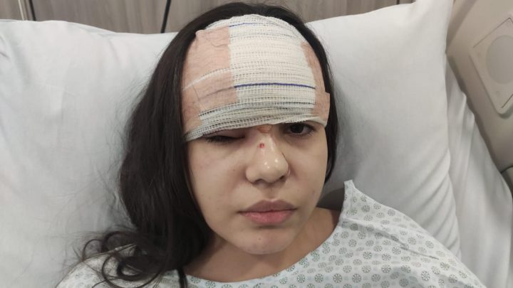 Universitária de Salgueiro que ficou 7 meses com caco de vidro do nariz faz novas cirurgias em SP