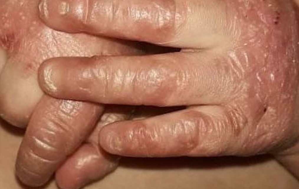 Bebê diagnosticado com doença rara e sem cura precisa de ajuda em Caruaru Bebê diagnosticado com doença rara e sem cura precisa de ajuda em Caruaru