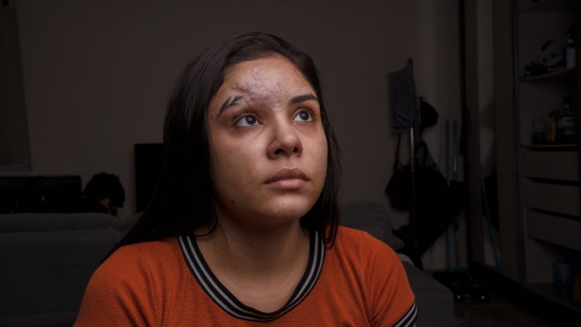 Estudante que teve rosto desfigurado move ação contra seguradora por danos morais Estudante que teve rosto desfigurado move ação contra seguradora por danos morais