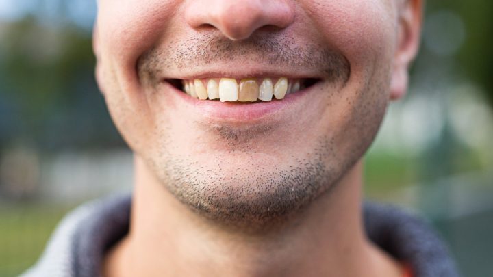Saúde bucal: saiba as causas das alterações do esmalte dentário e como tratar