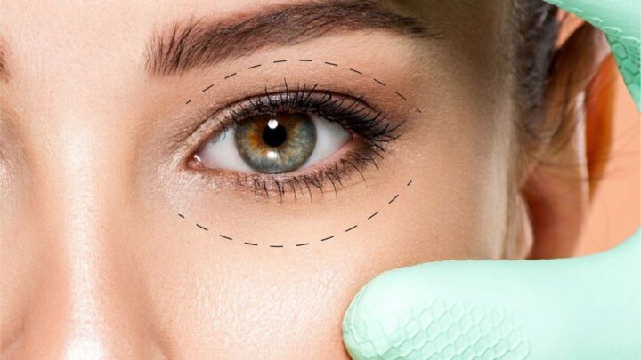 Brasil é o segundo país do mundo em cirurgias de pálpebra