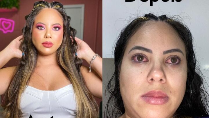 Chegada do Carnaval redobra os cuidados com a saúde ocular após explosão de casos de ceratite