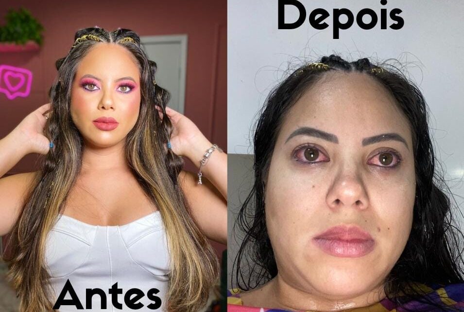 Chegada do Carnaval redobra os cuidados com a saúde ocular após explosão de casos de ceratite Chegada do Carnaval redobra os cuidados com a saúde ocular após explosão de casos de ceratite