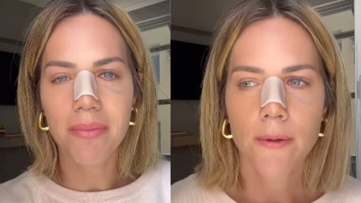 Entenda mais sobre a cirurgia de desvio de septo realizada pela atriz Giovanna Ewbank