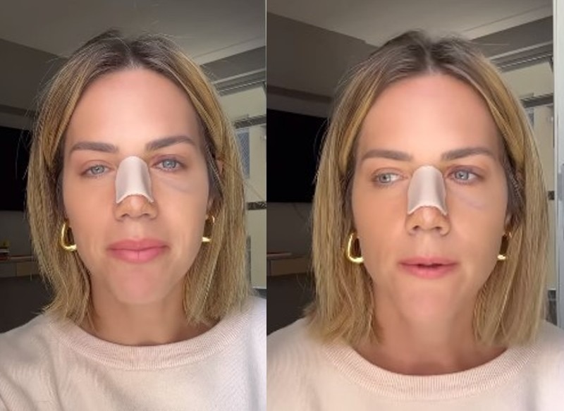 Entenda mais sobre a cirurgia de desvio de septo realizada pela atriz Giovanna Ewbank Entenda mais sobre a cirurgia de desvio de septo realizada pela atriz Giovanna Ewbank