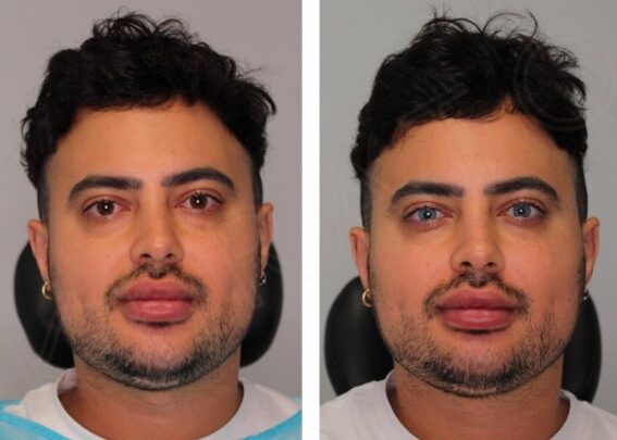 Homem muda permanentemente a cor dos olhos, mas especialistas alertam para risco do procedimento