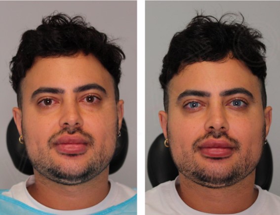 Homem muda permanentemente a cor dos olhos, mas especialistas alertam para risco do procedimento