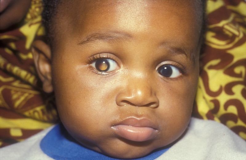 Retinoblastoma: tumor maligno ocular mais comum em crianças tem cura em 90% dos casos com diagnóstico precoce