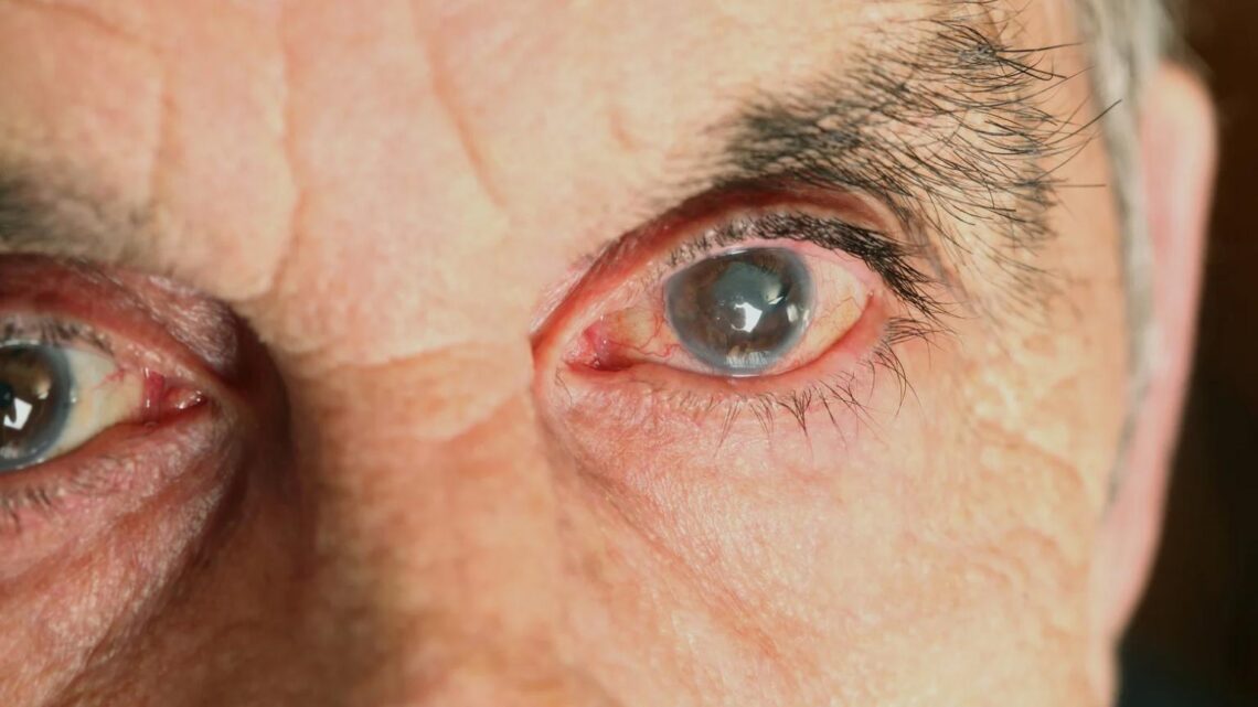 Maio Verde alerta para o glaucoma, principal causa de cegueira irreversível no Brasil