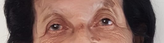 Catarata afeta milhões de brasileiros e segue como principal causa de cegueira evitável no país